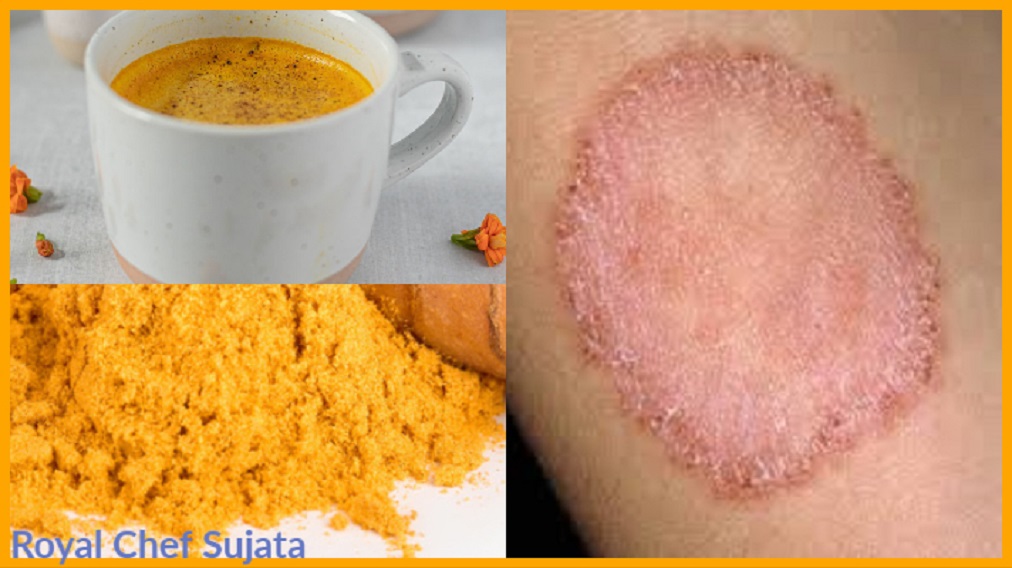 Home Remedies with Haldi for Ringworm and other Diseases